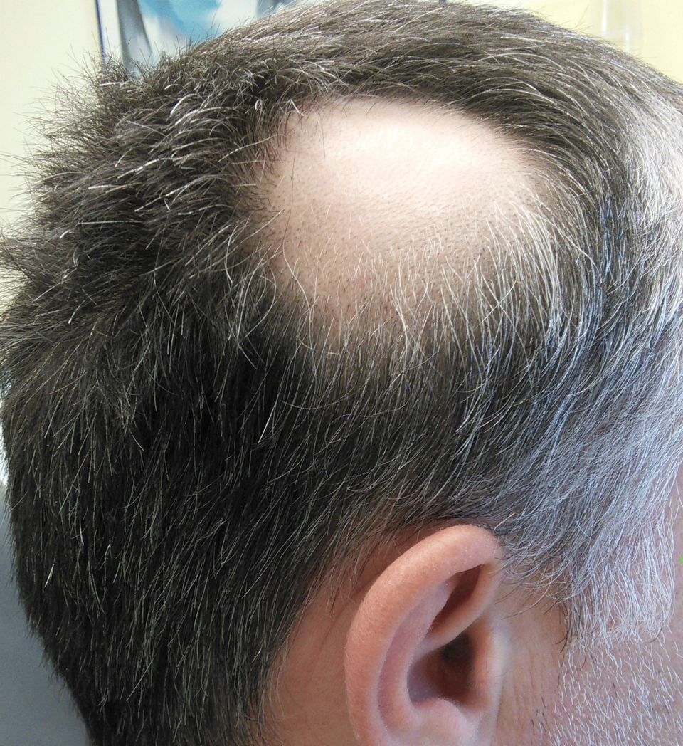 Alopecia areata am Kopf desselben Mannes.