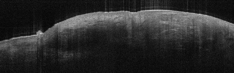 Das infiltrative (fibroisierende) BCC ist gekennzeichnet durch schmale dunkle Tumorzellverbände in der Dermis mit nur flachen, helleren Stromabereichen dazwischen – ein Muster, das an einen Fischschwarm erinnert.