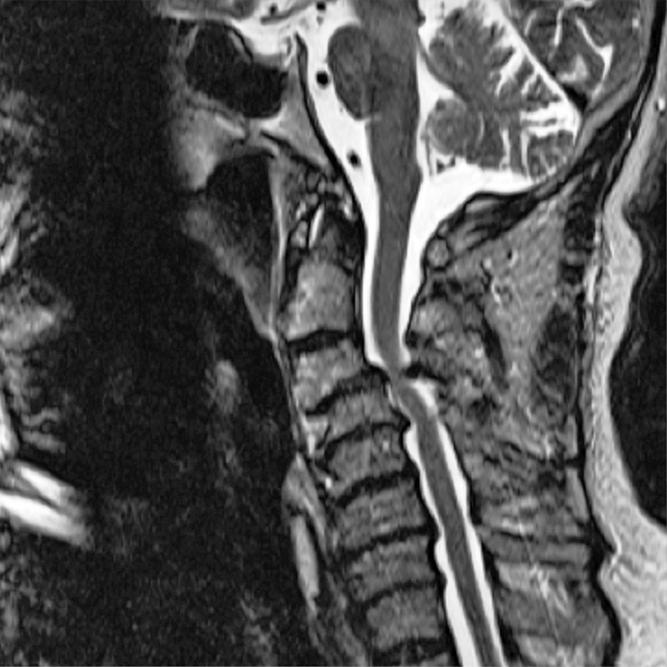 Durch die zervikale Spinalkanalstenose wird das Rückenmark komprimiert.