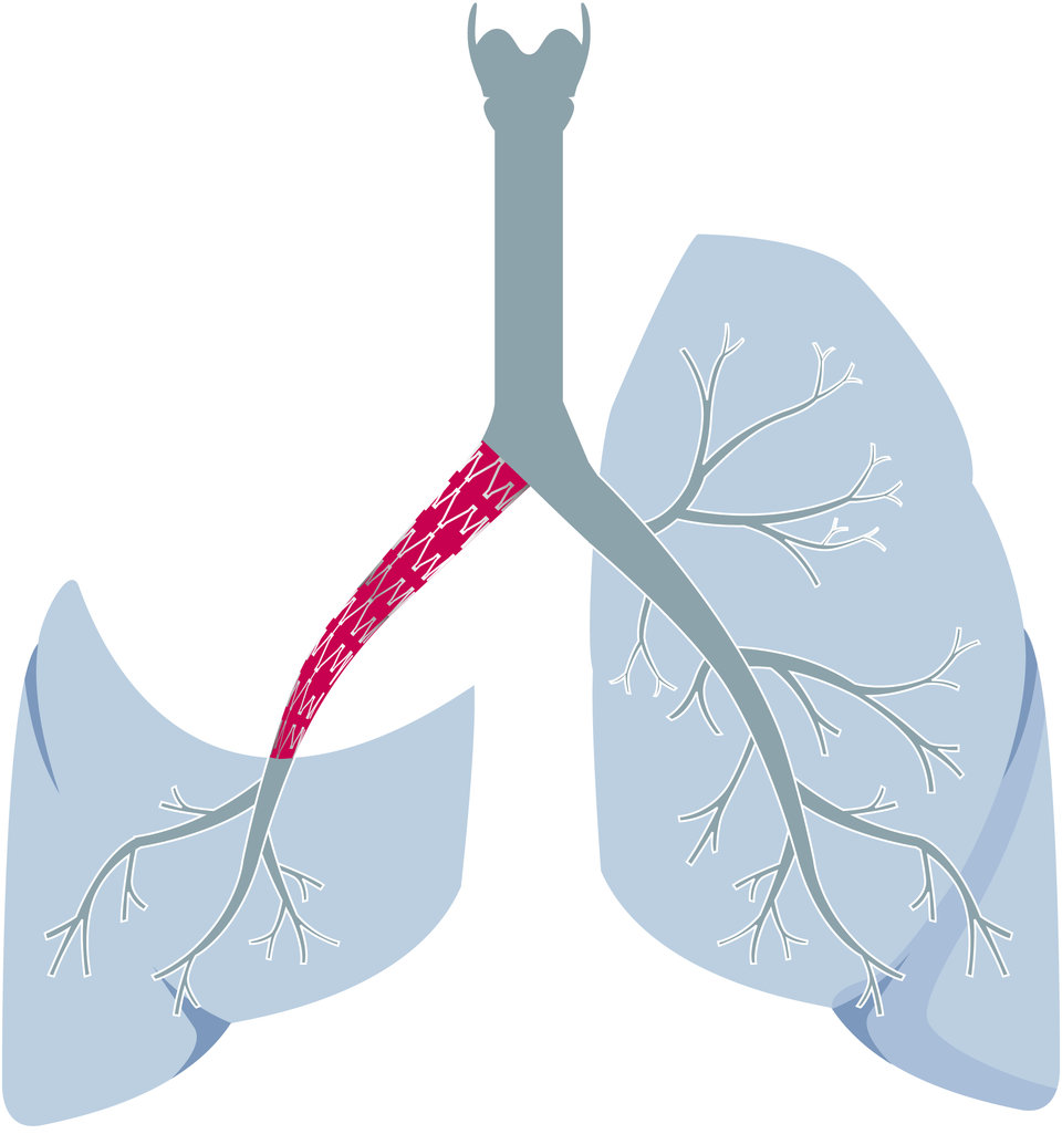 Auch das ist möglich: Nach einer Bilobektomie wird der verbleibende Unterlappen über ein Bronchustransplantat an die oberen Atemwege angeschlossen. 