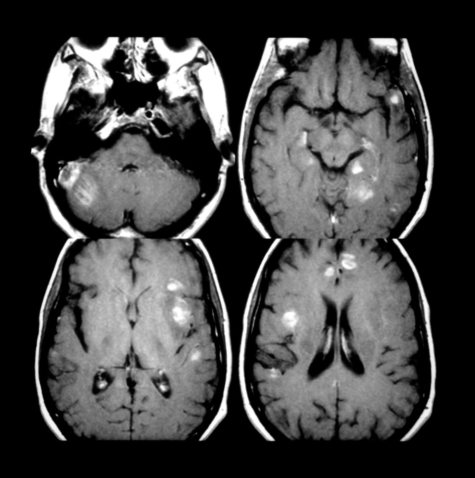 Die MRT-Bilder eines AIDS-Patienten zeigen multiple verstärkende (weiße) Läsionen der Toxoplasmose.