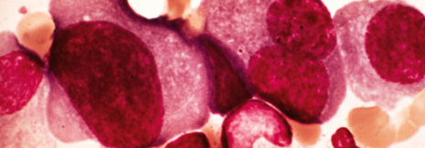 Multiples Myelom: Was hinter dem erhöhten Risiko bei rheumatoider Arthritis steckt