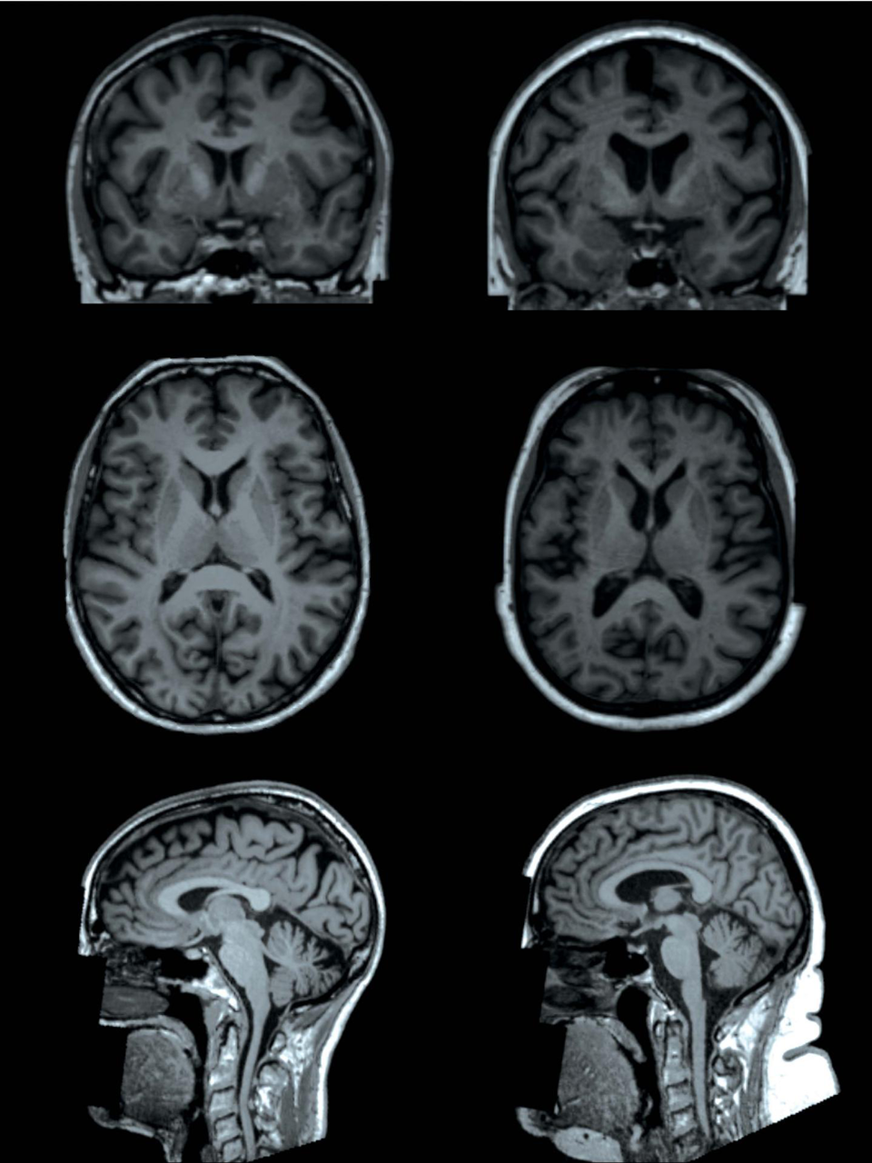 Zerebrales MRT von zwei Probandinnen der UK-Biobank-Studie. Eine hat einen Körperfettgehalt von 13 % (links), die andere einen von 49 % (rechts). Bei der adipösen Frau hat die subkortikale graue Substanz ein geringeres Volumen.