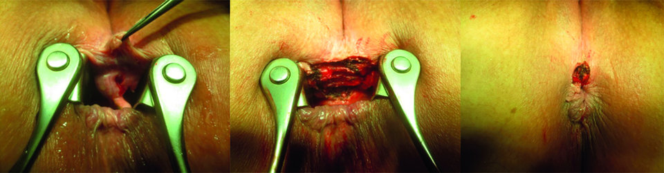 Seltener als die posteriore tritt eine anteriore Fissur auf. Bei dieser Patientin sind zudem eine Vorpostenfalte und eine hypertrophe Papille zu erkennen (1). Die Fissur wird samt
Begleiterscheinungen in einer Exzision nach Gabriel entfernt (2). Anstelle des chronischen Ulkus entsteht eine gut durchblutete Wunde, die in der Regel gut ausheilt (3).