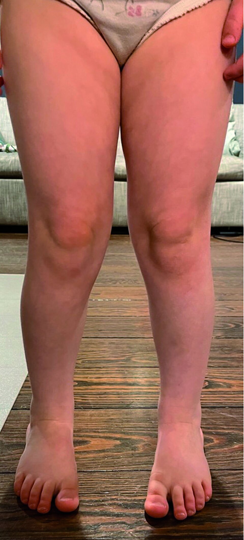 Abb.3: Genua valga bei einem vierjährigen Kind: Die Beinachsen werden im Stand bei zentrierter und nach ventral gerichteter Patella beurteilt. Dabei kann der intermalleoläre oder interkondyläre Abstand gemessen werden.