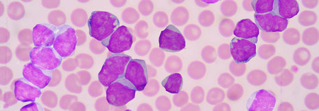 CAR-T-Zellen an- und ausschalten: Neues Konstrukt bei AML-Patienten getestet