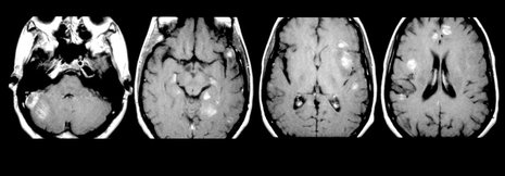 Empfehlungen zu HIV-1-assoziierten neurologischen Erkrankungen aktualisiert