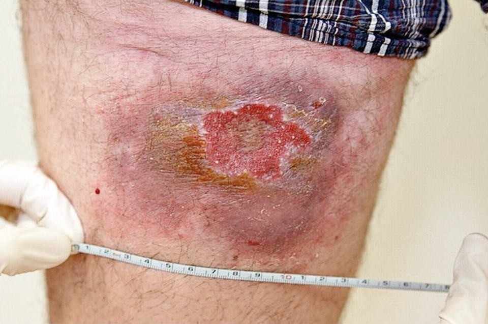 Nach zehn Jahren wurde die Leishmaniasis wieder aktiv. Der Grund war eine immunsupprimierende Psoriasis-Therapie. An der ursprünglichen Infektionsstelle bildete sich eine erythematöse, bläuliche Plaque (11 x 8 cm) mit nässendem zentralem Ulkus auf 4,5 x 3 cm.