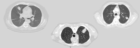 Lungenkrebsscreening: Wie geht es nach dem auffälligen Befund diagnostisch weiter?