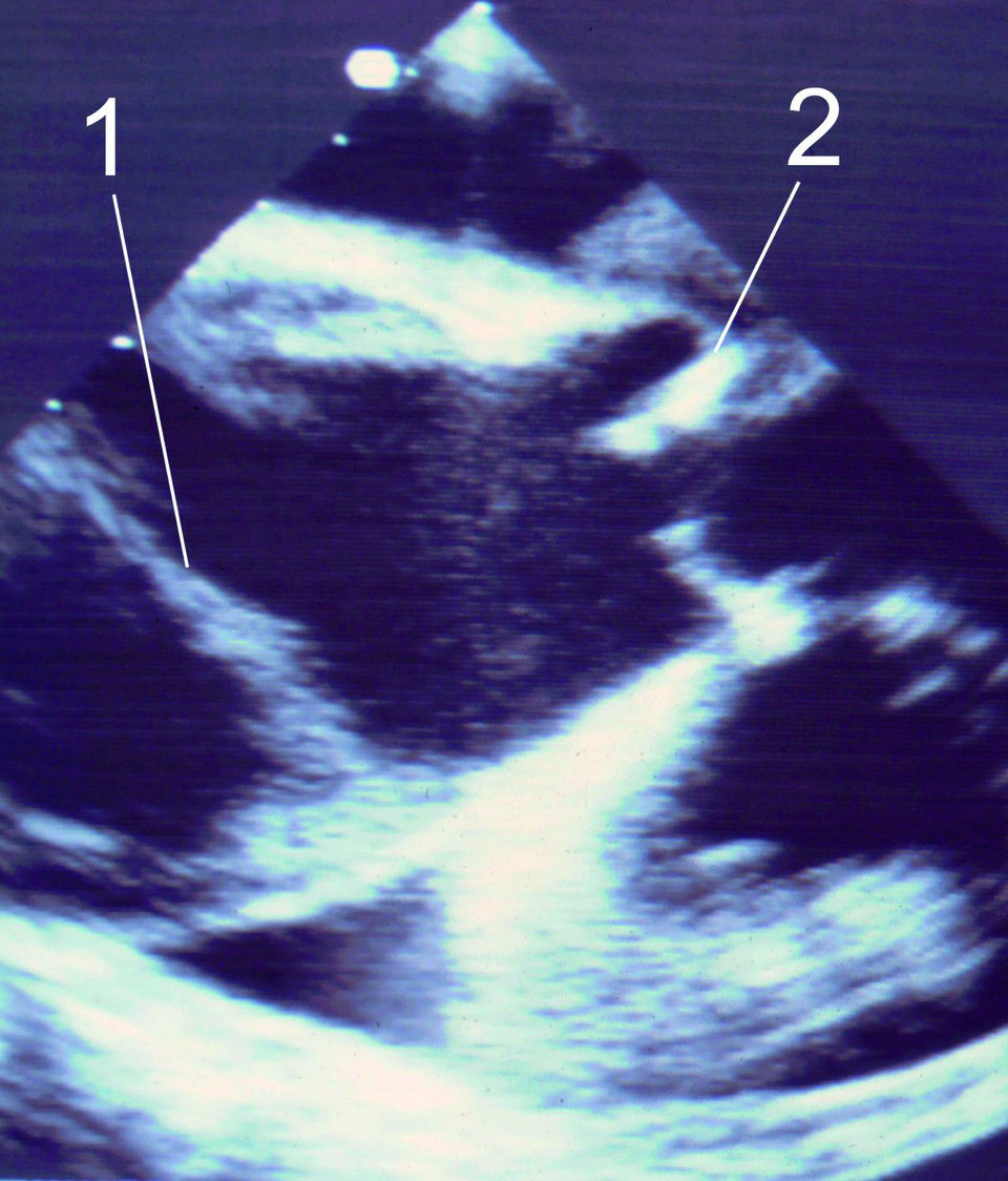 Das Herzecho bietet dem geschulten Auge eine rasche initiale Diagnostik. Zu erkennen ist die Dissektionsmembran (1) nahe der Aortenklappe (2).