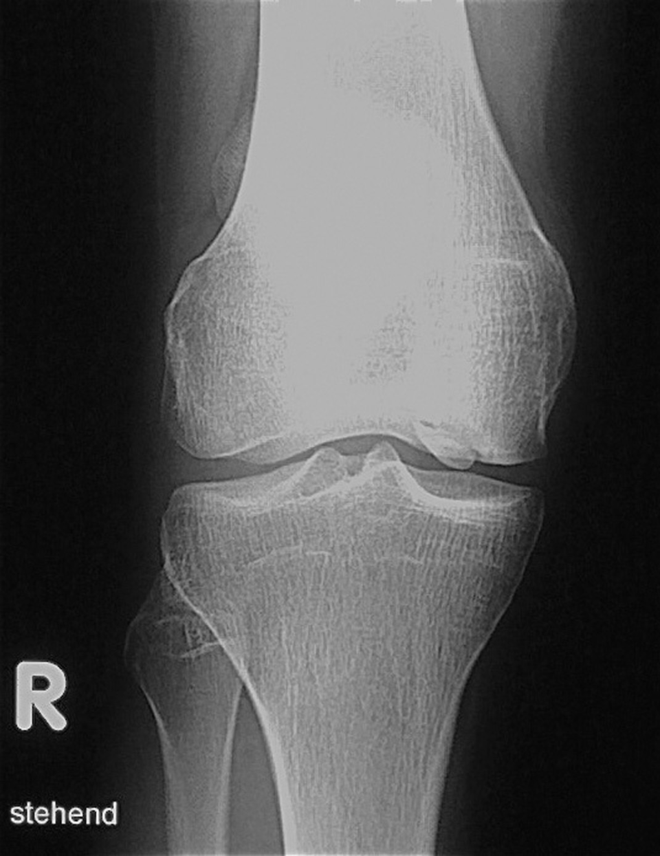 Ein Kniekiller: die Osteochondrosis dissecans. Die „Gelenkmaus“ hängt im medialen Kondylus.