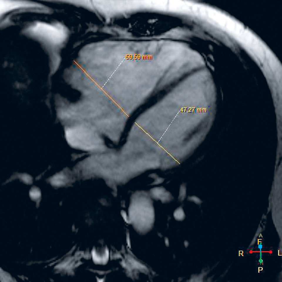 Das MRT brachte die Fehleinmündung der oberen rechten Pulmonalvene in die Vena cava superior ans Licht 