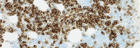 Smouldering Myelom: Tripletherapie verzögert Manifestation des Multiplen Myeloms