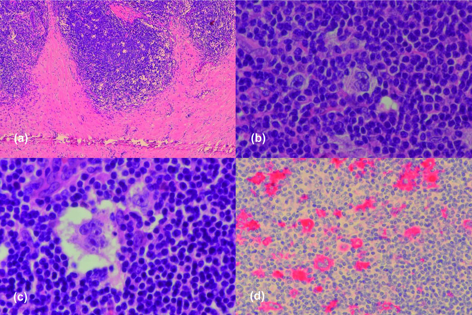 In der Histologie des mediastinalen Knotens ließen sich Hodgkin- und Sternberg-Reed-Zellen anfärben.
