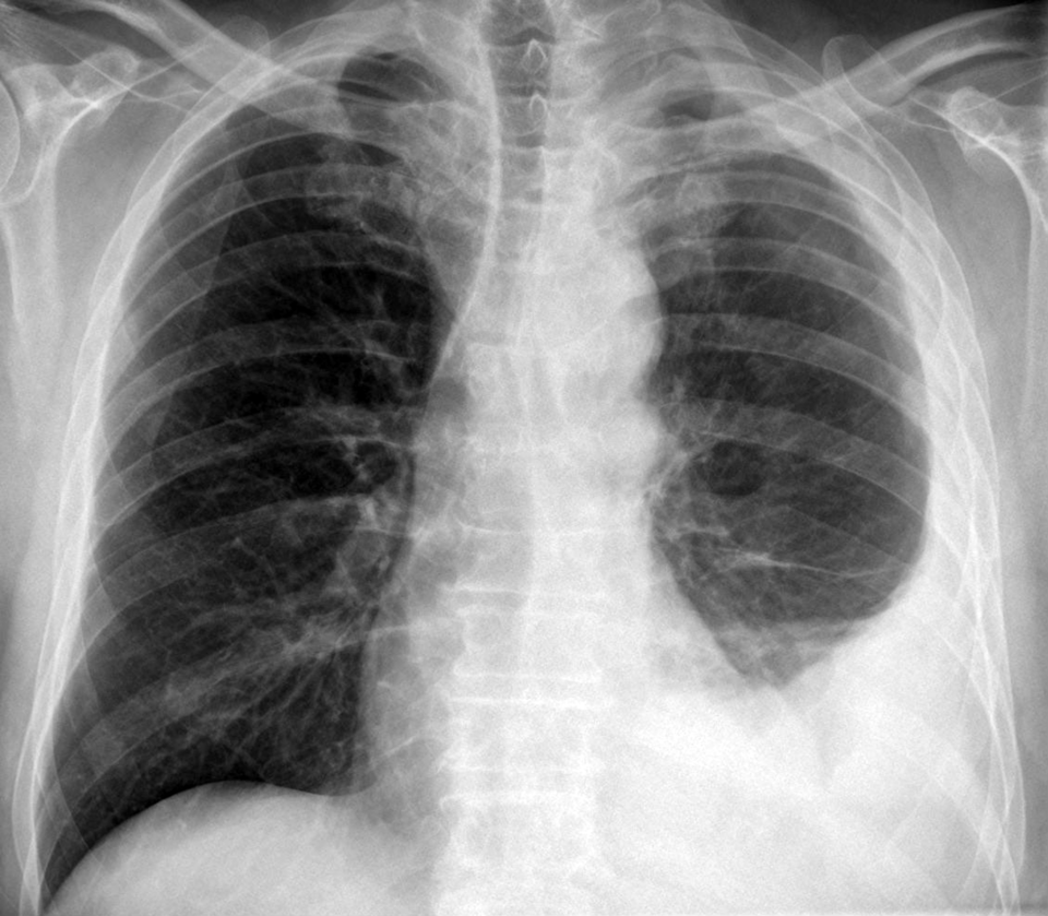  Pleuramesotheliom im Röntgenbild des Thorax: Pleuraverdickung und -erguß links.