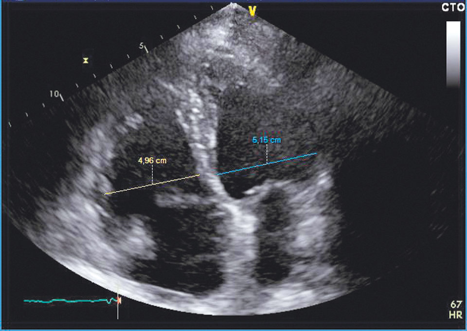 Das Echo zeigt den vergrößerten rechten Ventrikel mit pulmonal-arterieller Hypertonie