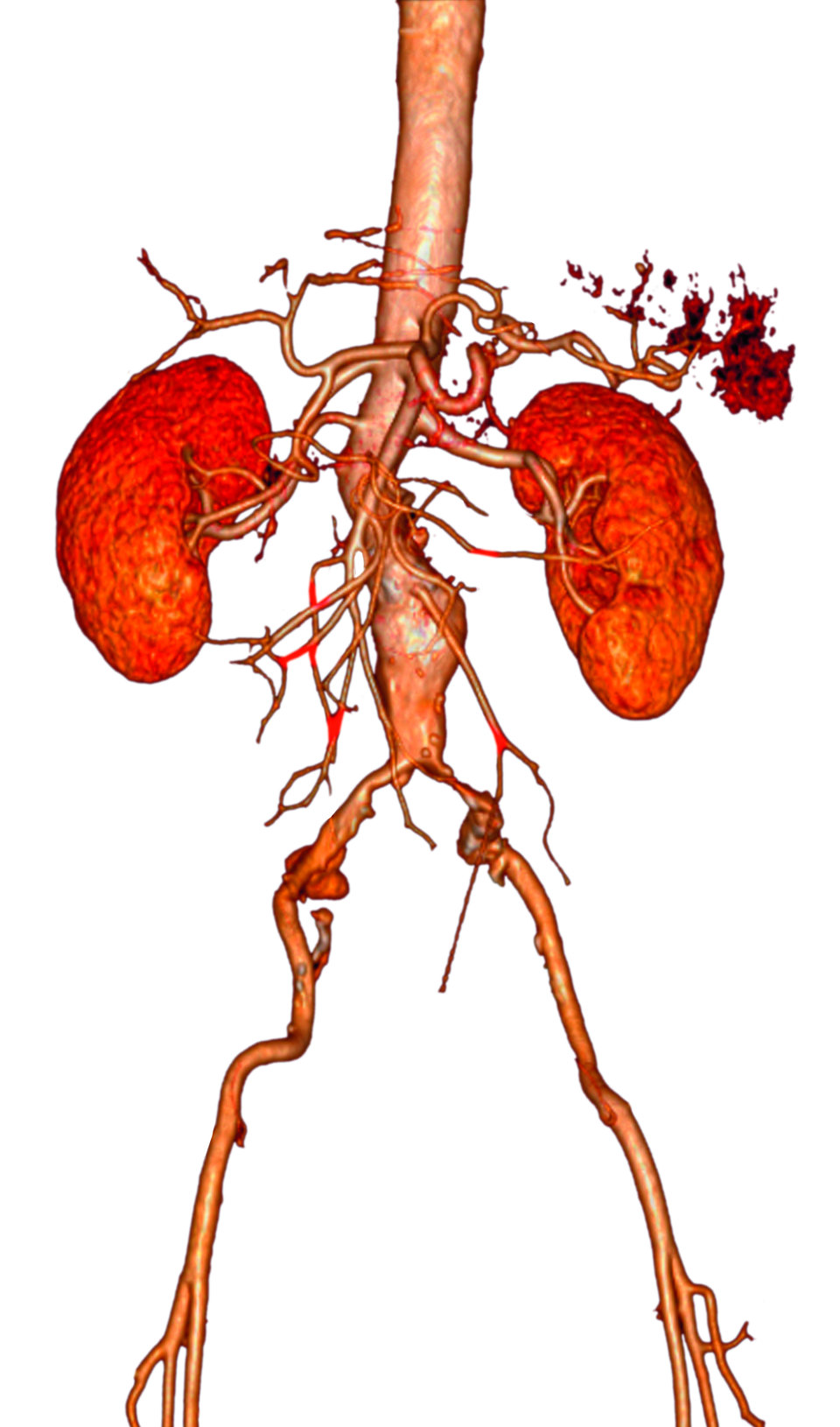 Bauchaorten­aneurysma im Verhältnis zu den Nierenarterien