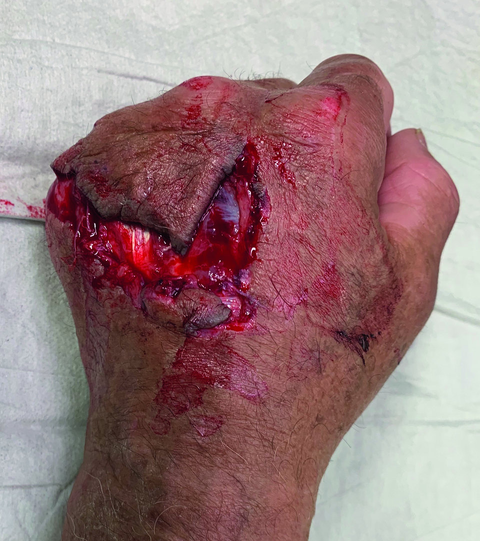 Bei diesem 76-Jährigen hatte ein Hund zugebissen.