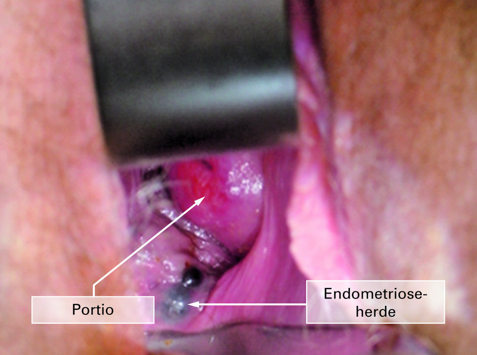 Die Herde der Endometriosis genitalis externa an der Vagina sind bei der körperlichen Untersuchung deutlich zu erkennen.