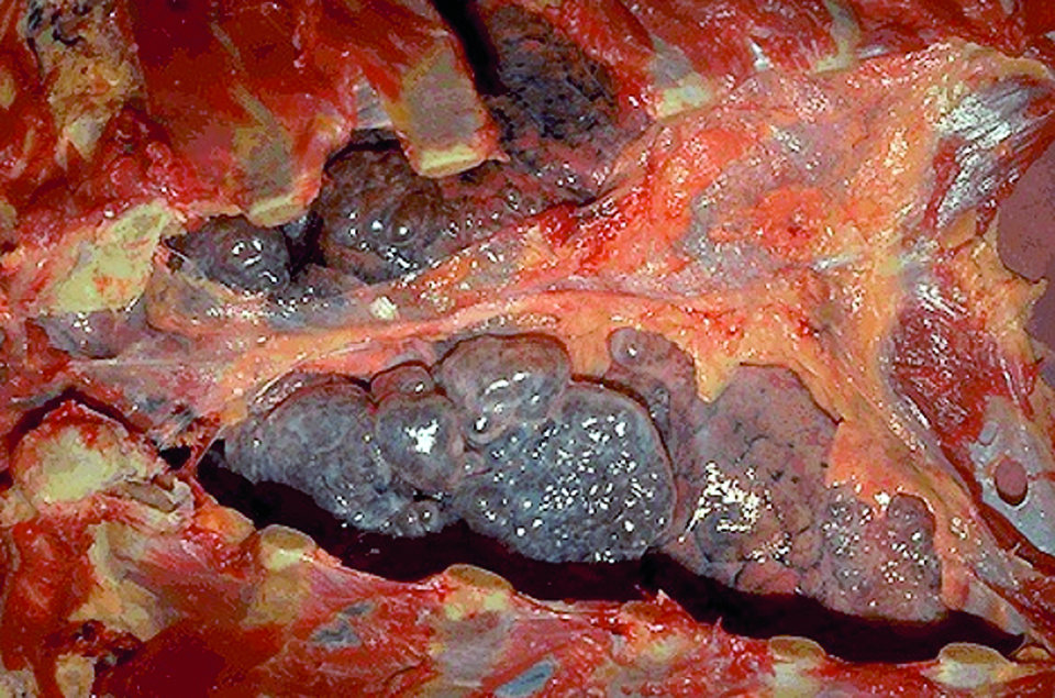 Bullöses Emphysem