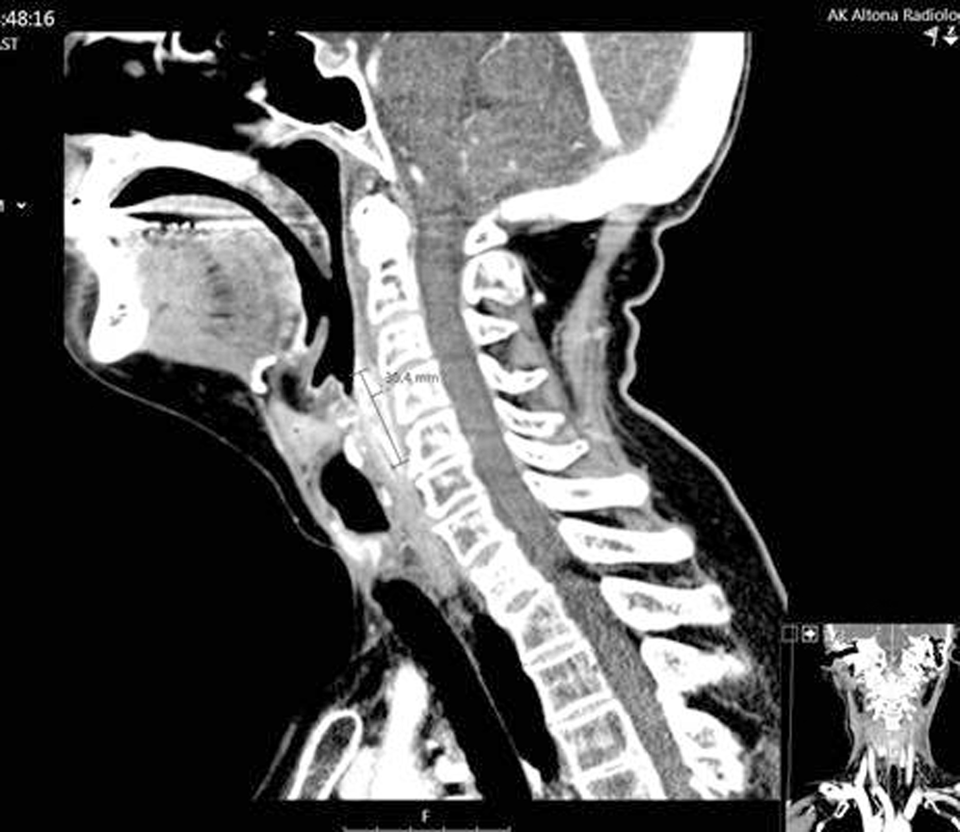 1. Im CT des Halses ist der zirkulär wachsende Tumor am proximalen Ösophagus gut zu sehen.