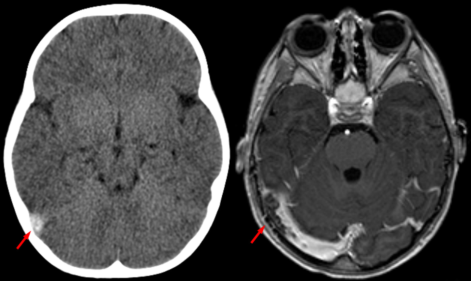 Sinusvenenthrombose.