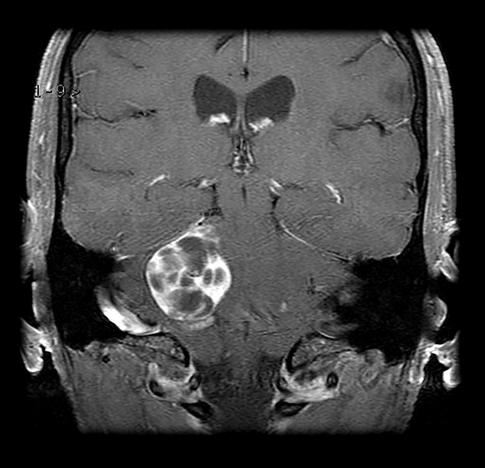 Vestibuläre Schwannome wie hier im Bereich von Pons und anteriorem Cerebellum können Ohrgeräusche auslösen.
