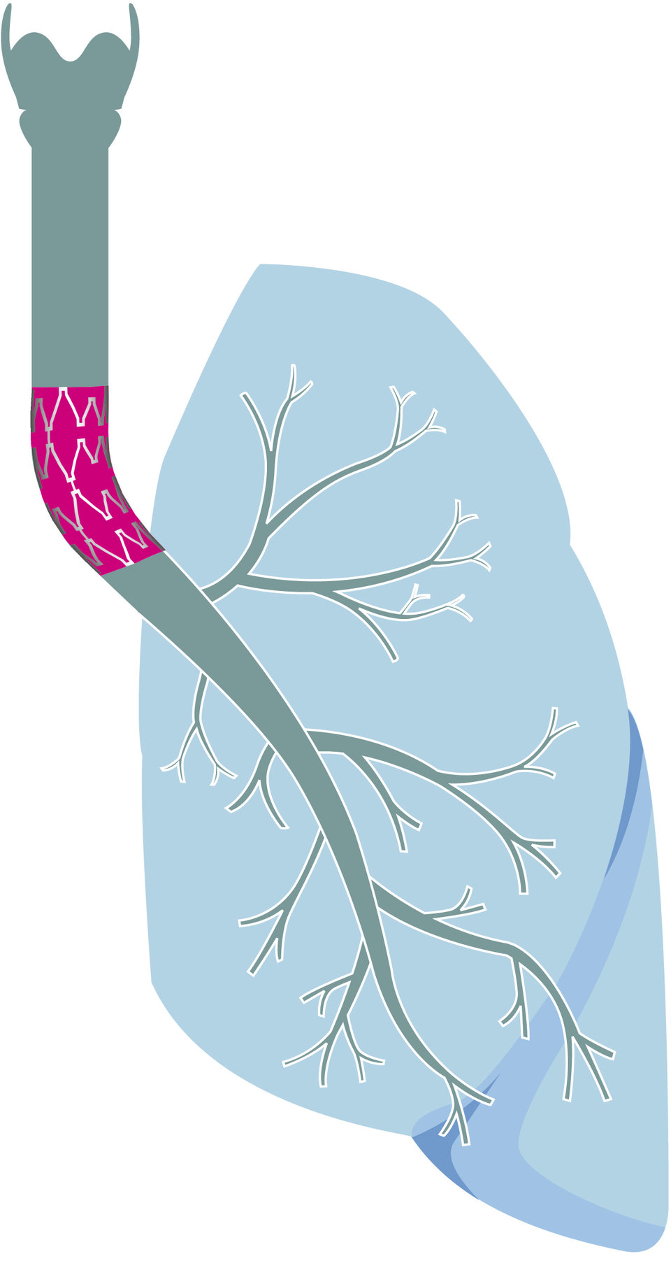 Bei einer Patientin entfernte man den rechten Lungenflügel und auch ein Stück der Luftröhre. Um die Belüftung der linken Lunge zu ermöglichen, erhielt sie ein Transplantat im Bereich der Carina.