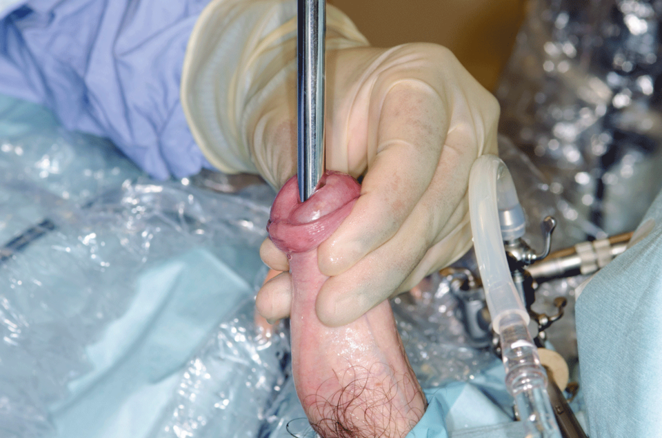 Die Urethra-Dilatation (Bougierung) dient lediglich der temporären Miktionsbesserung und nicht der dauerhaften Sanierung.
