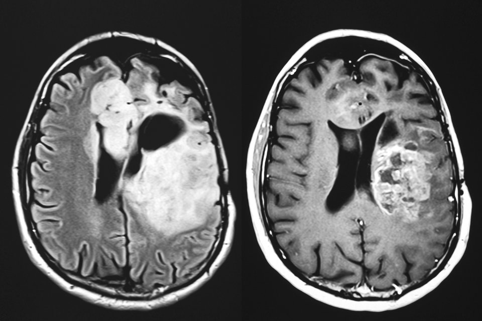 Endlich Therapie-Fortschritte bei sekundären ZNS-Lymphomen Therapie-Fortschritte bei sekundären ZNS-Lymphomen.
© thinkstock