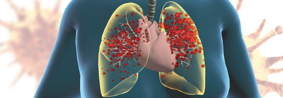 Pneumokokken sind bei COVID-19 ein besonderes Risiko – auch und vor allem für Menschen mit Diabetes.