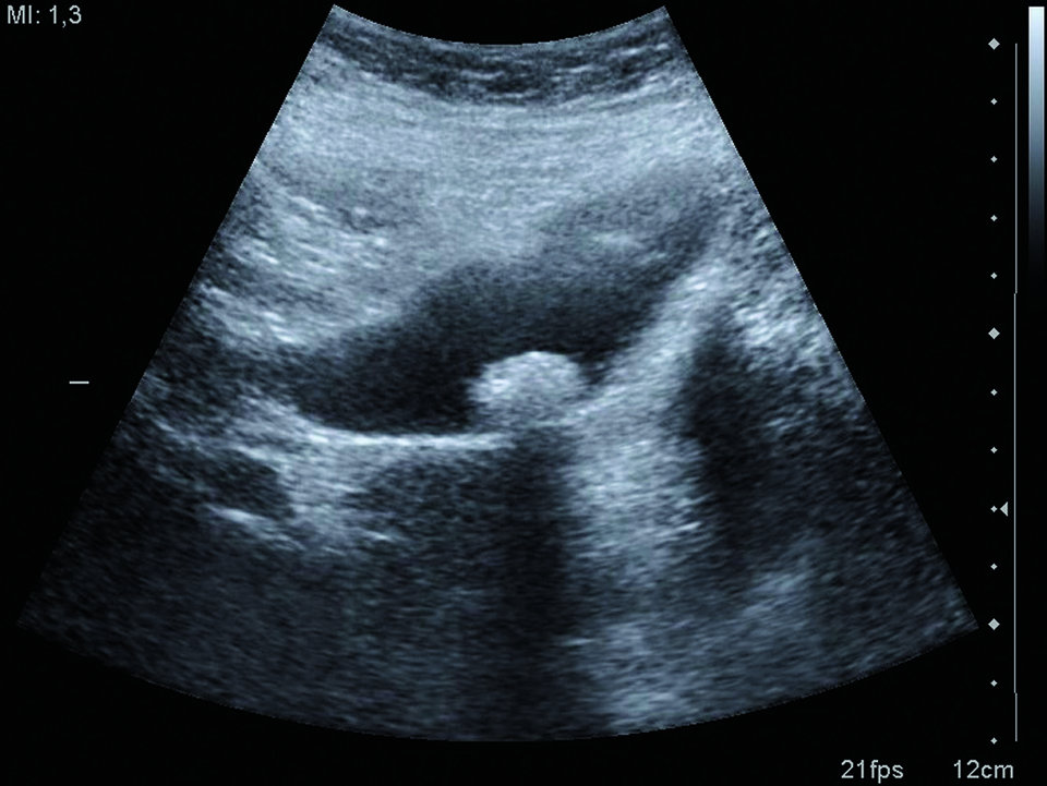 Ist eine Gallengangsbeteiligung wahrscheinlich, folgt die endoskopische retrograde Cholangiographie (ERC) mit Sphinkterotomie und Steinextraktion beziehungsweise die Anlage einer ­Drainage.