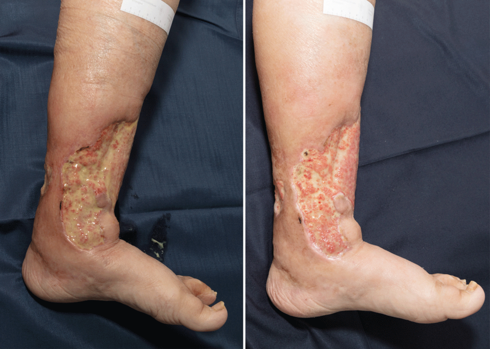 Wundreinigung mit Mikrofaser, Fliegenlarven und Ultraschall Das Pyoderma gangränosum dieser Patientin wurde mit einem ultraschallassistierten Verfahren gereinigt. Damit kann man vorhandene Granulationsknospen geschont freilegen. Wichtig: Die Wundreinigungsollte bei dieser Erkrankung erst nach der Stabilisierung durch eine immunsuppressive Therapie erfolgen.