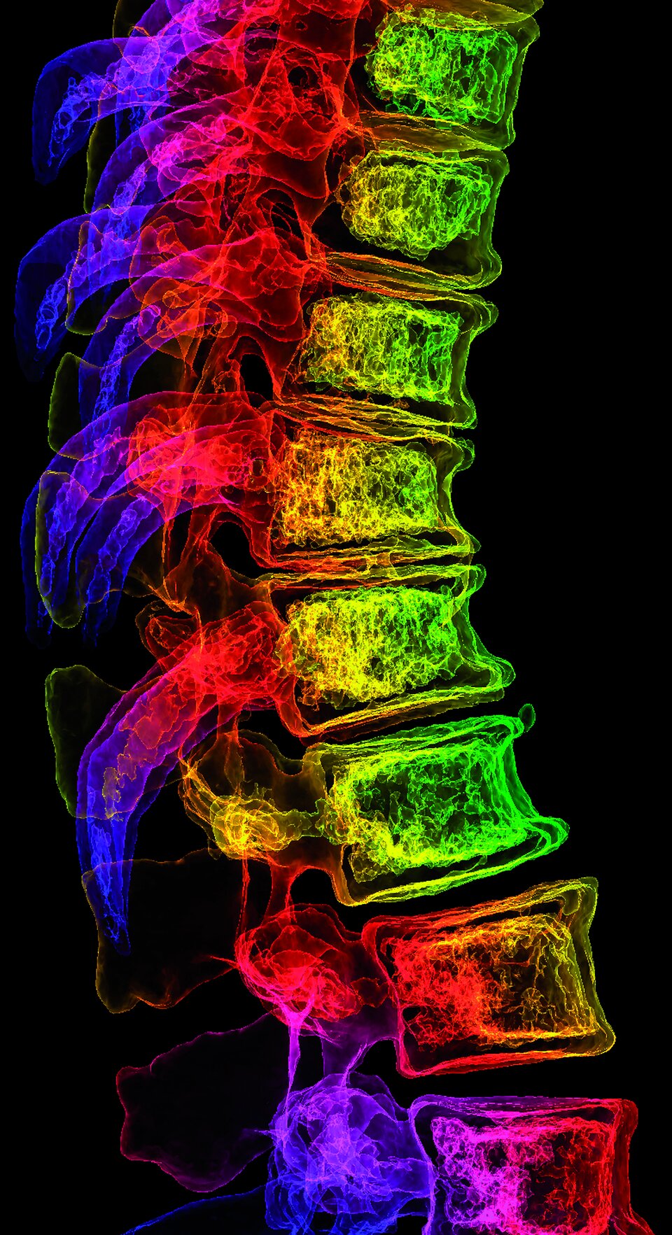 Osteoporotische Verringerung der Wirbelkörperhöhe und Kyphose im 3D-CT-Scan.
