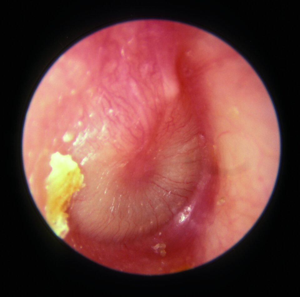 Otitis media mit mukopurulentem 
Exsudat, vorgewölbtem Trommelfell und dilatierten Trommelfellgefäßen.