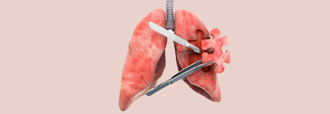 NSCLC: Segmentresektion für ausgewählte Patienten geeignet