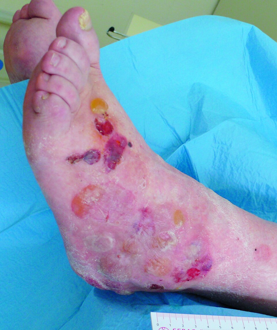 Abb. 2: Typisch für das Abullöse Pemphigoid sind prall gefüllte Blasen auf ekzematös veränderter Haut. Die Mundschleimhaut ist meist ausgespart.