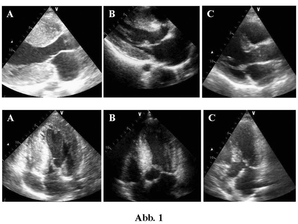 Die Echokardiographie von drei Geschwistern mit HOCM zeigt die deutliche Variabilität der Hypertrophie in Diastole (oben) und Systole (unten).