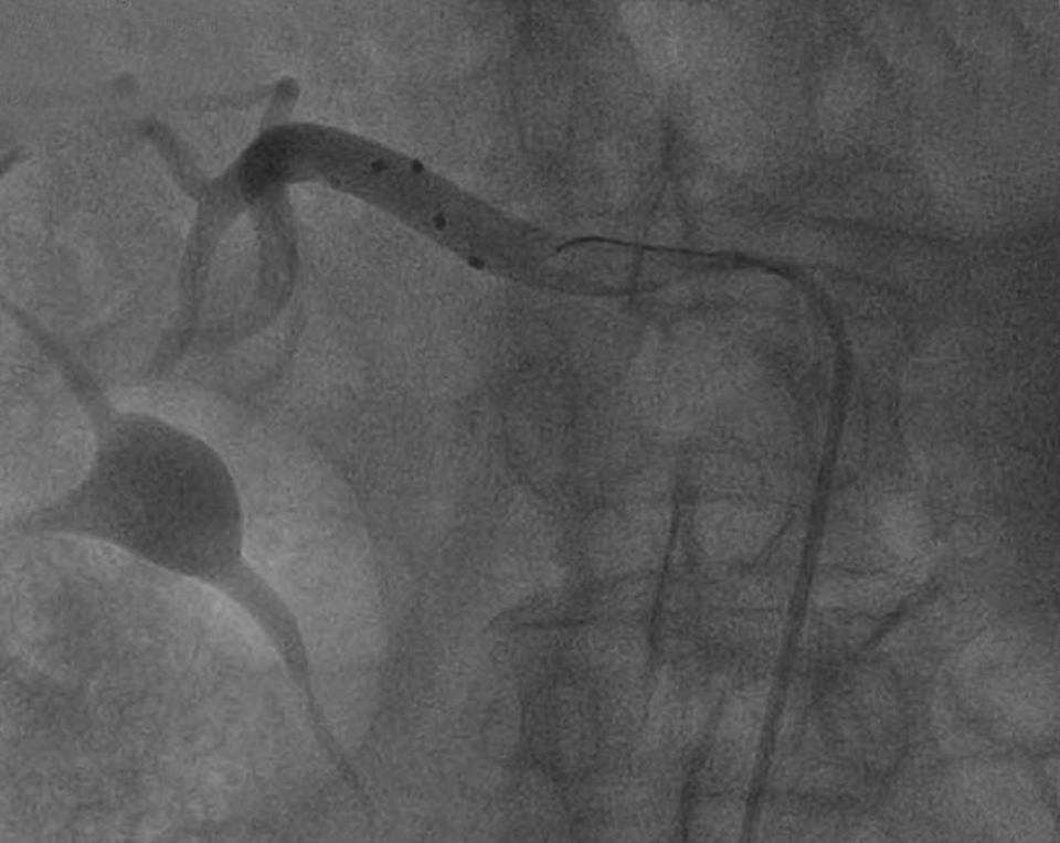 Radiofrequenz­ablation in Aktion: Die schwarzen Punkte sind die vier Elektroden.