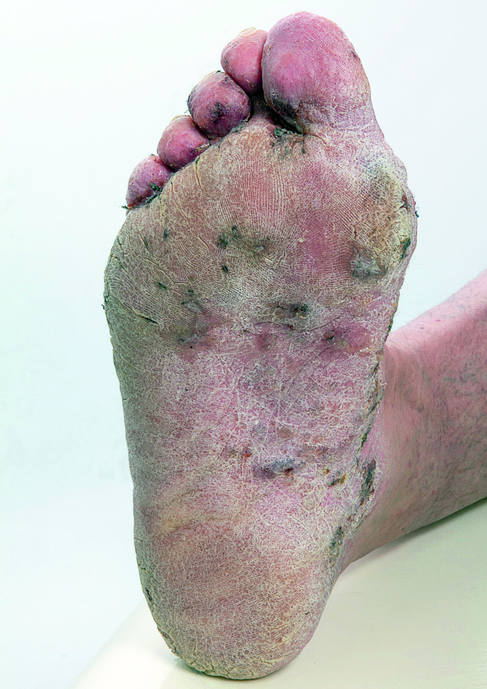 Bakterieller Fußinfekt mit gelb-bräunlichen, schmierigen Belägen in den Zehenzwischenräumen und plantarer Hyperkeratose mit Rhagaden.