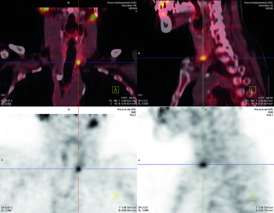 Der Ultraschall ist die Standard­untersuchungsmethode zur Lokalisations­diagnostik. Gleichzeitig kann damit auch die Schilddrüse untersucht werden. Hier ist ein Nebenschilddrüsenadenom zu erkennen (sagittal).