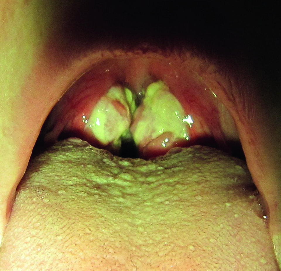 Hyperplastische Tonsillen mit Fibrinbelägen: Sieht der Rachen so aus, liegt eine EBV-Infektion nahe.