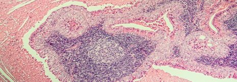 B-Zell-Lymphome: die Qual der Wahl