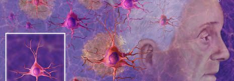 Antikörpertherapie der Alzheimerdemenz kann nicht voll überzeugen