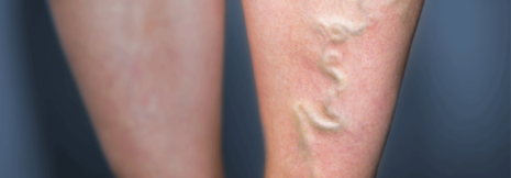 Antikoagulation bei Beinvenenthrombosen im Unterschenkel?
