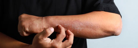 Atopische Dermatitis: Baricitinib plus TCS bessert Hautbild