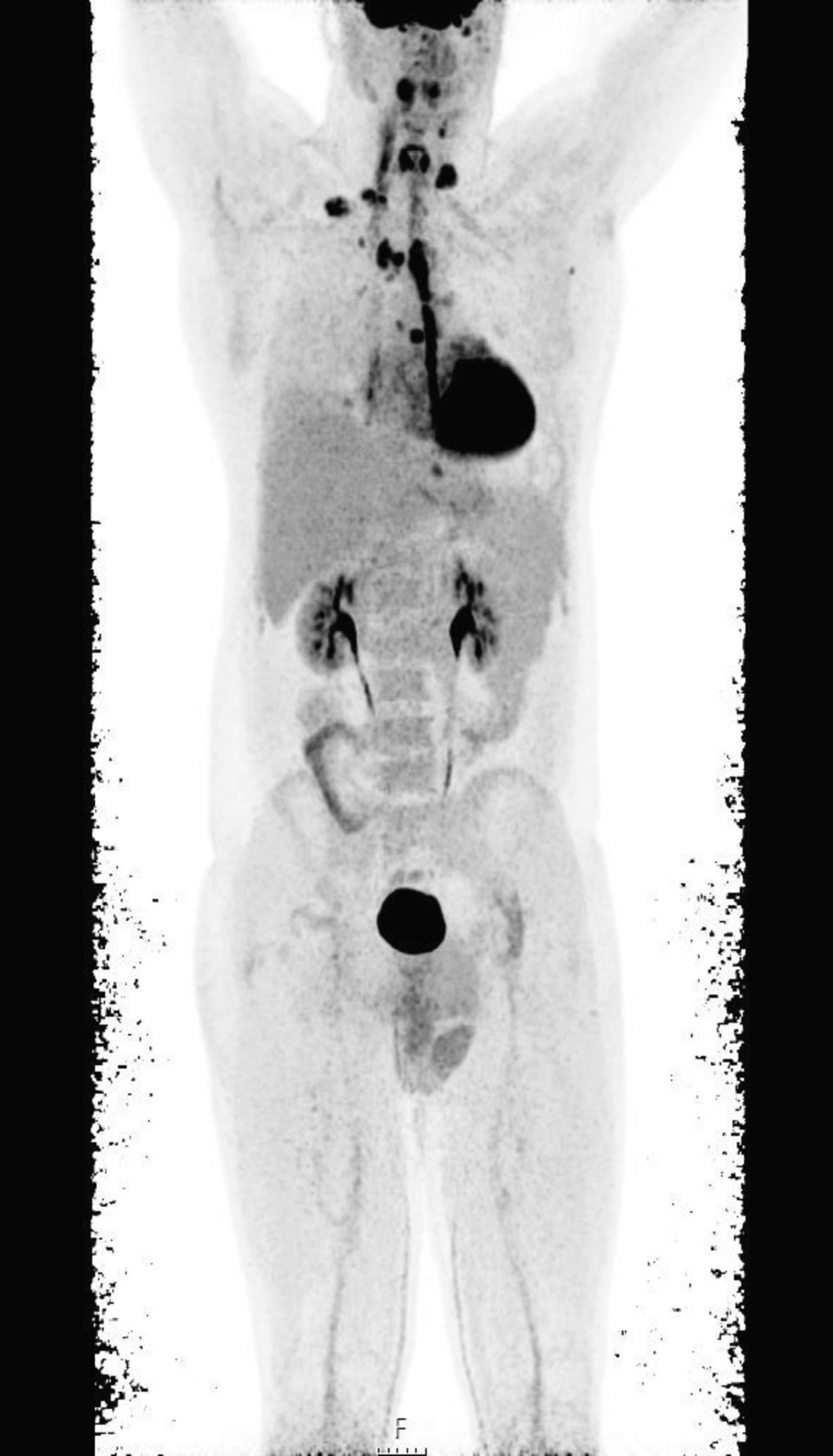 Das Ausmaß der Tumorerkrankung wurde mittels PET-CT deutlich: Mehrere Lymphknotenareale waren befallen.