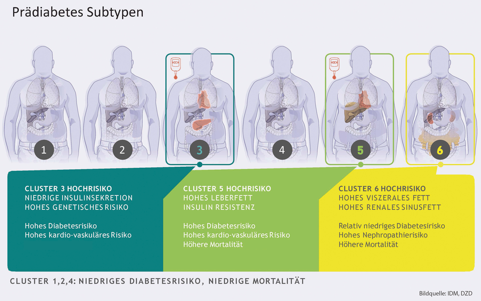 Subtypen des Prädiabetes
