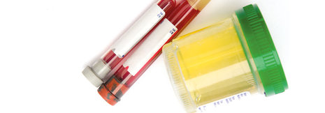 Nierenschäden über Blut und Urin richtig diagnostizieren