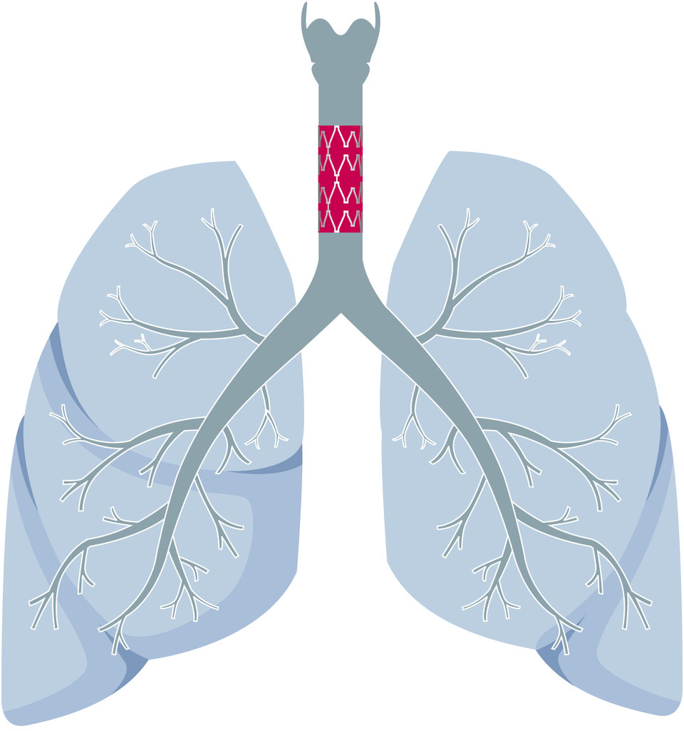 Fünf Patienten bekamen ein Luftröhrentransplantat, drei wegen einer benignen Trachealstenose (bei einem kam eine Malazie der oberen Atemwege hinzu), zwei aufgrund eines Schilddrüsenmalignoms. 